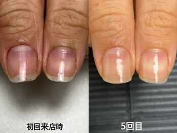 【自爪育成】３ヶ月コース