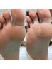 【タコ・魚の目】足裏上半分　数に限らず一律！！　¥5,500