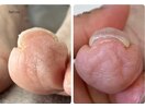 巻き爪ケア8