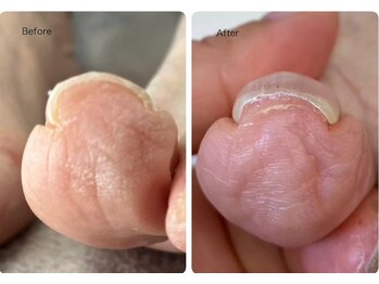 ロンディネ(Rondine)/巻き爪ケア8