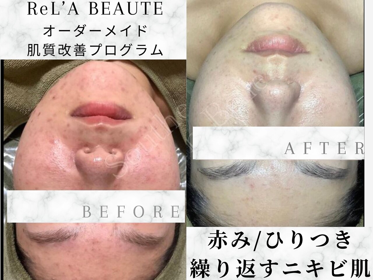 4ページ目｜チノザメソッド 口コミに関するエステサロン bell