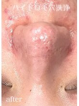 ドクターエイチ 四ツ橋堀江店(Doctor.H)/ハイドロ毛穴洗浄