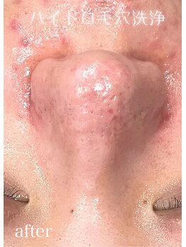 ドクターエイチ 四ツ橋堀江店(Doctor.H)/ハイドロ毛穴洗浄