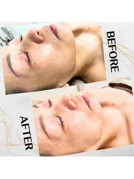 キラリ(Kirari)/次世代ハーブピーリング