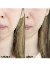 毛穴塾/話題の小顔マイクロリフト