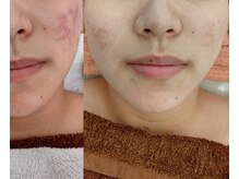 マリヴェリーテ(Mari verite)/ニキビ×毛穴改善【17回】