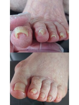 エンネイル(en.nail)/巻き爪