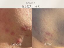 ベルダ(BELDAD)/【ニキビケアBefore After】