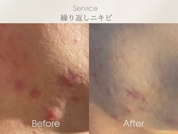 フェイシャルサロン ベルダ(BELDA)/【ニキビケアBefore After】