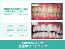 クレア(Crea)/【歯のホワイトニング症例写真】