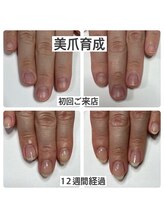 マニュコクーン(ManuCocoon)/爪育成　深爪　巻き爪　大阪市