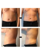 伊達男/フォースカッター事例