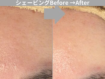 ももとゆでたまご/お顔そり before→after