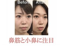 ラプリボーテ(Raplit BEAUTE)/隆鼻＋輪郭矯正40分10回