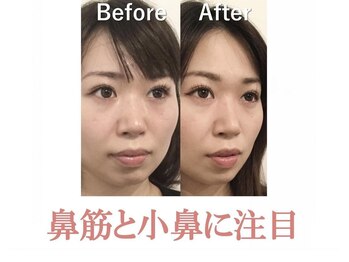 ラプリボーテ(Raplit BEAUTE)/隆鼻＋輪郭矯正40分10回