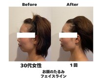 ラナン パラフューズ(Ranun's PARAFUSE.)/横顔美人に♪更に目も大きく♪