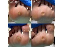 巻き爪補正店 和 光市店の雰囲気（タコ・魚の目施術のビフォーアフター。タコ/魚の目/角質ケア）