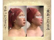 サンテボーテ(Sante Beaute)/40代の顔たるみに終止符