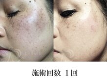 パルファンカルム 駅西本町店/シミ・くすみの排出力アップ！