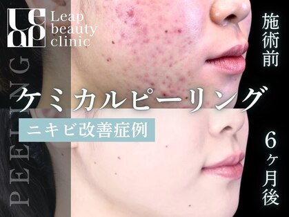 リープ(Leap)の写真