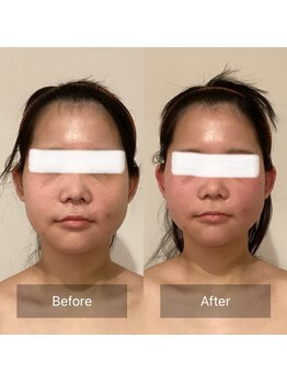 アラマンダ(Allamanda)/輪郭3点BeforeAfter