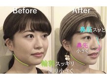 ラプリ 大宮店(Raplit)/隆鼻＋輪郭矯正40分10回