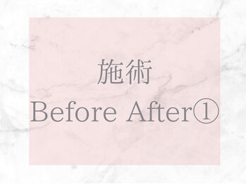 ネオファースト(NeoFirst)/《当店人気メニューの症例写真》