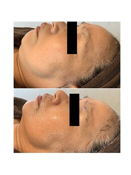 ヴィオテラス(VIOTERACE)/☆★小顔フェイシャル☆