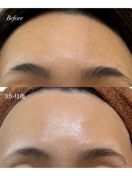 ジューンブライド(June Bride 61)/肌改善プログラム