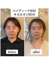 ヨサパーク カルム(YOSA PARK)/ハイディーナ×ルルオン60分