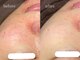 セレーノ 白金台(seReno)の写真/大人の#韓国肌管理で肌リセット!結果重視のピーリングが充実＊ララピール/ハーブ/カクテル/ICU/潤艶WAX◎