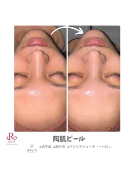 アクシア ビューティー サロン(AXSIA)/【REVI陶肌ピール】