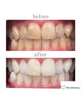 NA ホワイトニング 川崎溝の口店/ホワイトニング/川崎/溝の口