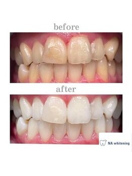 NA ホワイトニング 川崎溝の口店/ホワイトニング/川崎/溝の口