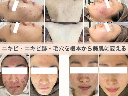 ニキビ研究所 千葉店の写真