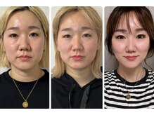 【結果重視】圧倒的小顔、お顔全体のたるみケアはテラボーラー◎