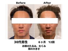 ラナン パラフューズ(Ranun's PARAFUSE.)/むくみが取れると小顔になる♪