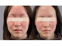 リズ(rE:S)/韓国インモードリフティング20代