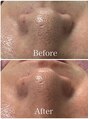 【肌質改善】Pua Pua Facial 【プアプアフェイシャル】&nbsp;がんこな毛穴詰まりもお任せください♪