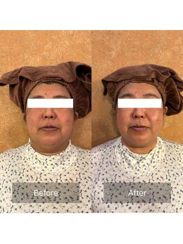 シュウエナジー(Shu)/脂肪分解 | 小顔・顔リフト