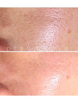 サロン ド カリナン(salon de Cullinan)/プラスマ照射で毛穴ケア