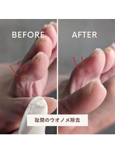 リットフット(LitFoot)/趾（あしゆび）間のウオノメ除去