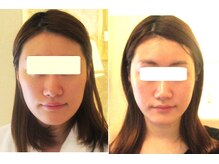 サロンドエステケイワイ(de KY)/フェイシャル☆小顔・タルミ改善