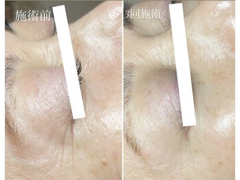 テテメルティ(te-te melty)/プロセルセラピーズ