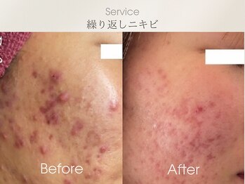 フェイシャルサロン ベルダ(BELDA)/【ニキビケアBefore After 】