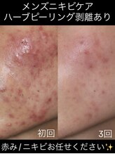 ソアン(Soin)/ニキビにさよなら