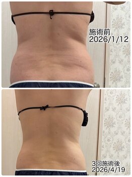 クールスパ(COOL SPA)/40代背中症例