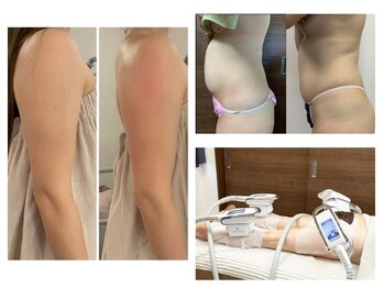 ソフィームの写真/二の腕/ハミ肉に集中ケア◎大人気★脂肪冷却×EMSで脂肪細胞に徹底アプローチ♪[立川/痩身/ダイエット]