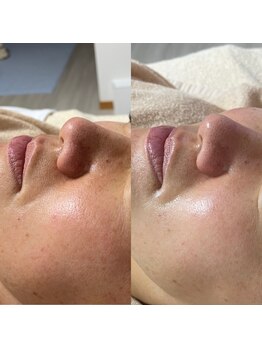 エミニティ トータルビューティーサロン(Eminity)/エイジングケアフェイシャル