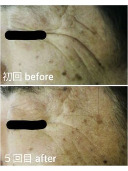 かとう鍼灸整骨院/◆７０代男性　５回の施術例